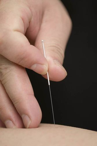 Agulha utilizada na acupuntura Agulha utilizada na acupuntura
