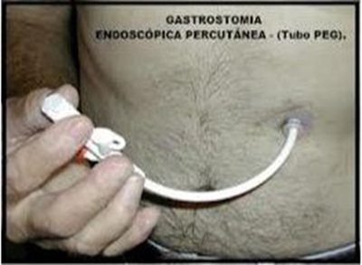 Gastronomia Percutânea Gastronomia Percutânea